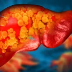 A New Frontier in Hepatology: Experimental Drug ION224 Targets the Root Cause of MASH