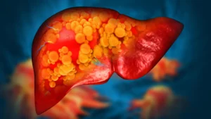 A New Frontier in Hepatology: Experimental Drug ION224 Targets the Root Cause of MASH