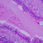A New Frontier in Oncology: Revolution Medicines’ Daraxonrasib Shatters Pancreatic Cancer Survival Benchmarks