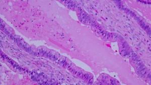 A New Frontier in Oncology: Revolution Medicines’ Daraxonrasib Shatters Pancreatic Cancer Survival Benchmarks