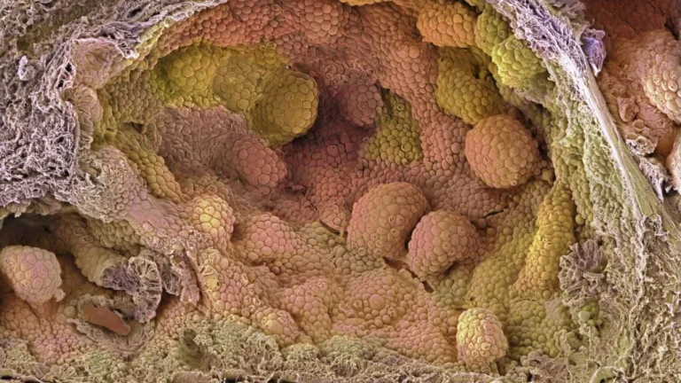A New Standard? PROTEUS Trial Signals Paradigm Shift in High-Risk Prostate Cancer Treatment