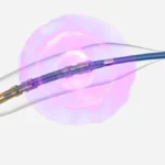 Advancing Cardiovascular Care: Boston Scientific Announces Positive FRACTURE Trial Results for Seismiq IVL