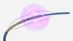 Advancing Cardiovascular Care: Boston Scientific Announces Positive FRACTURE Trial Results for Seismiq IVL