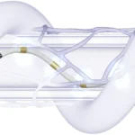 Advancing Hypertension Management: Medtronic’s Symplicity Spyral Shows Sustained Efficacy in High-Risk Patient Cohorts
