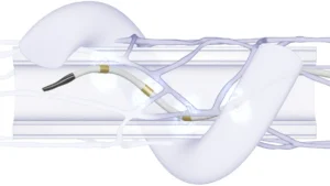 Advancing Hypertension Management: Medtronic’s Symplicity Spyral Shows Sustained Efficacy in High-Risk Patient Cohorts