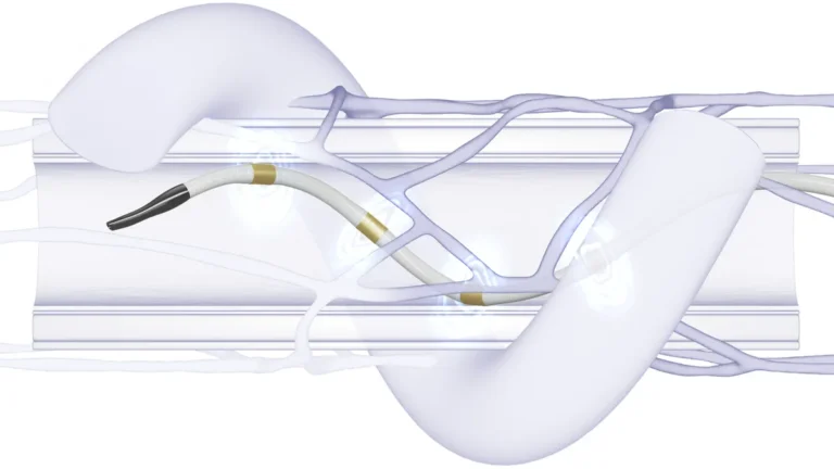 Advancing Hypertension Management: Medtronic’s Symplicity Spyral Shows Sustained Efficacy in High-Risk Patient Cohorts
