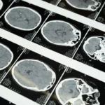 Beyond "All in Your Head": New Scientific Insights into the Cervical Spine and hEDS