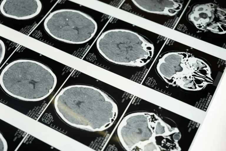Beyond "All in Your Head": New Scientific Insights into the Cervical Spine and hEDS
