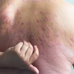 Beyond the Skin: Breakthrough Trial Shows Dual-Action Therapy Transforms Psoriasis and Metabolic Health