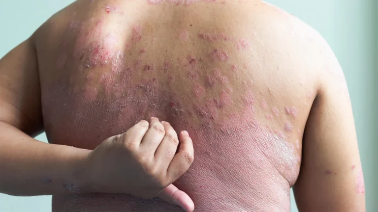 Beyond the Skin: Breakthrough Trial Shows Dual-Action Therapy Transforms Psoriasis and Metabolic Health