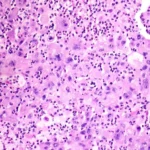 Breakthrough in Lung Cancer Treatment: The Kelun-Merck Sac-TMT Clinical Success