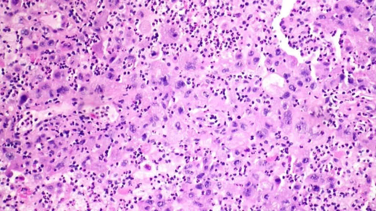 Breakthrough in Lung Cancer Treatment: The Kelun-Merck Sac-TMT Clinical Success