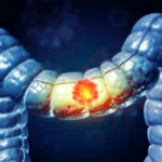 Breakthrough in Oncology: Immunotherapy Before Surgery Transforms Colorectal Cancer Treatment