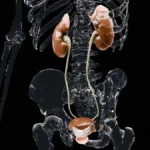 Breakthrough in Overactive Bladder Treatment: Implantable Tibial Nerve Stimulation Shows Promise in Pivotal Trial