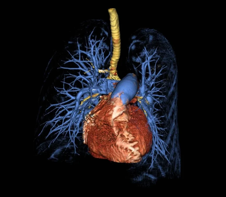 Breakthrough in Pulmonary Hypertension: Ralinepag Phase 3 Results Signal a New Era in PAH Treatment