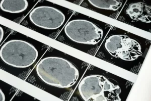 Bridging the Diagnostic Gap: New Research Illuminates the Head, Neck, and hEDS Connection