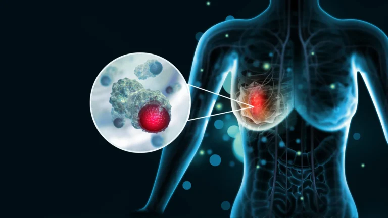 Decoding the Microenvironment: The BRIDGE Initiative’s Quest to Revolutionize Breast Cancer Treatment