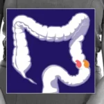 Decoding the Tumor: The Race to Revolutionize Immunotherapy for Colorectal Cancer