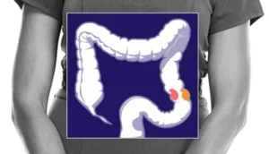 Decoding the Tumor: The Race to Revolutionize Immunotherapy for Colorectal Cancer