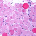 Legal Showdown: Capricor Therapeutics Sues Partner Over “Fatal Flaw” in Duchenne Therapy Rollout