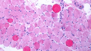 Legal Showdown: Capricor Therapeutics Sues Partner Over “Fatal Flaw” in Duchenne Therapy Rollout