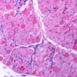 Navigating Uncertainty: Regenxbio Faces Regulatory Crossroads for Duchenne Gene Therapy RGX-202