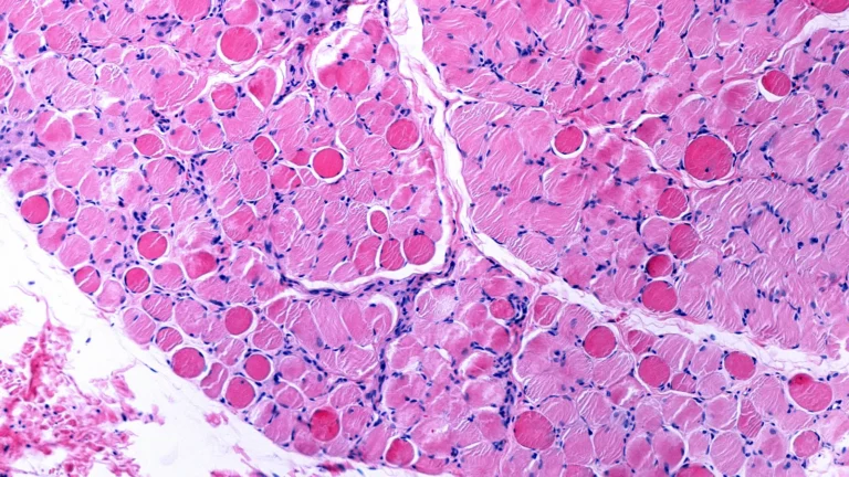 Navigating Uncertainty: Regenxbio Faces Regulatory Crossroads for Duchenne Gene Therapy RGX-202