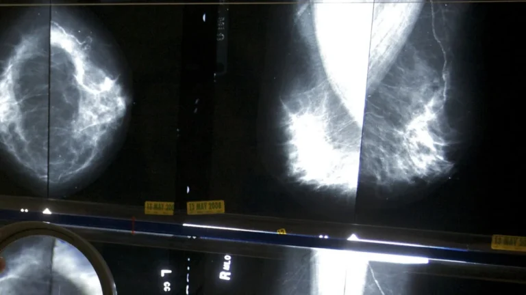 The Great Mammogram Debate: Why Routine Screening Guidelines Remain a Moving Target