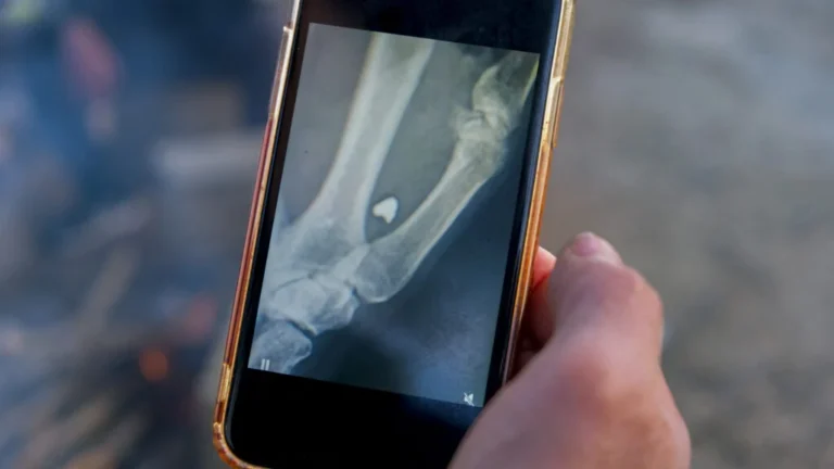 The Invisible Burden: The Long-Term Health Crisis of Retained Bullet Fragments