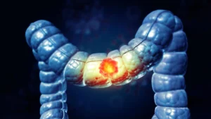 The Silent Surge: Why Colorectal Cancer is Striking Younger Adults