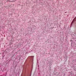 A New Frontier in Myelofibrosis: Eli Lilly’s Novel JAK2 Inhibitor Shows Promise in Early Trials