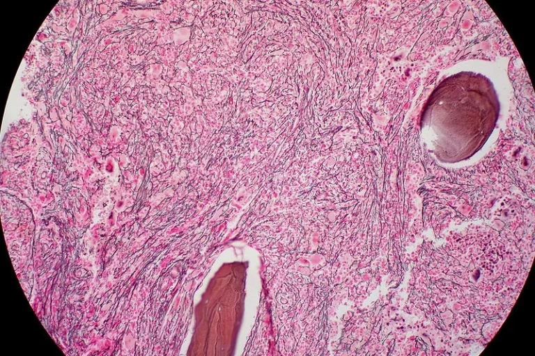 A New Frontier in Myelofibrosis: Eli Lilly’s Novel JAK2 Inhibitor Shows Promise in Early Trials