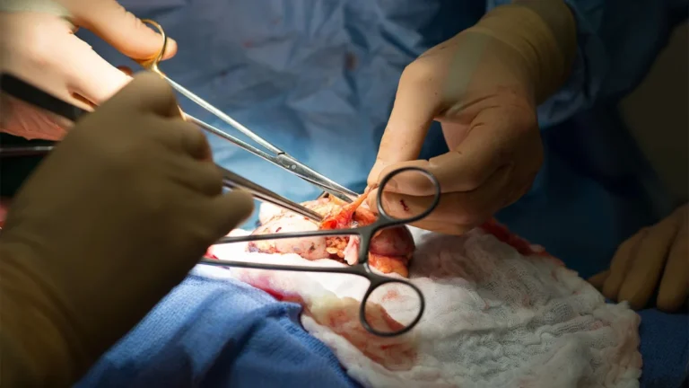 A New Frontier in Transplantation: Dual CAR T-Cell Therapy Offers Hope for Highly Sensitized Patients