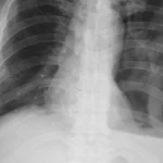 Aidoc Secures FDA Breakthrough Designation for AI-Driven Chest X-Ray Reporting