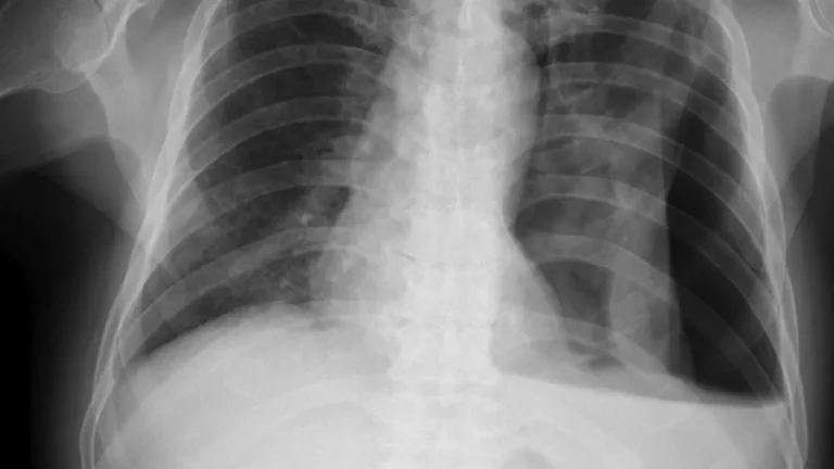 Aidoc Secures FDA Breakthrough Designation for AI-Driven Chest X-Ray Reporting