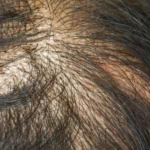 Beyond the Weight-Loss Boom: The New Frontier of Hair Regrowth and Aesthetic Medicine