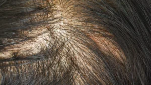 Beyond the Weight-Loss Boom: The New Frontier of Hair Regrowth and Aesthetic Medicine