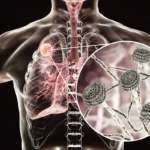 Breakthrough in Antifungal Therapy: Phase 3 OASIS Trial Validates Olorofim for Invasive Aspergillosis