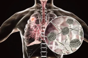 Breakthrough in Antifungal Therapy: Phase 3 OASIS Trial Validates Olorofim for Invasive Aspergillosis