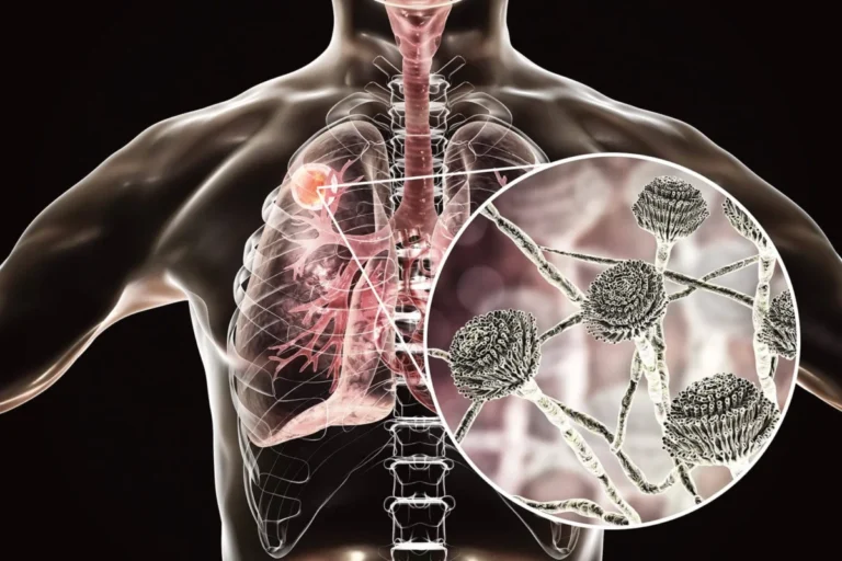 Breakthrough in Antifungal Therapy: Phase 3 OASIS Trial Validates Olorofim for Invasive Aspergillosis