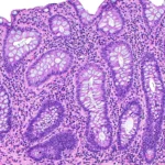 CAMPfield Therapeutics Emerges with $180M Series A to Disrupt the IBD Treatment Landscape