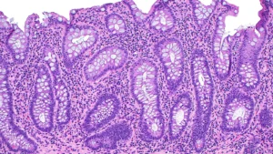 CAMPfield Therapeutics Emerges with $180M Series A to Disrupt the IBD Treatment Landscape