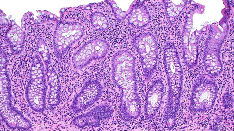 CAMPfield Therapeutics Emerges with $180M Series A to Disrupt the IBD Treatment Landscape