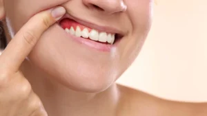 Fasting for a Healthier Smile: How Caloric Restriction Could Combat Gum Disease