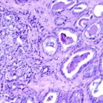 Innovation in Prostate Cancer Treatment: MultiValent Biotherapies Secures $27M Series A to Launch U.S. Trials