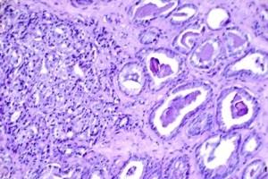 Innovation in Prostate Cancer Treatment: MultiValent Biotherapies Secures $27M Series A to Launch U.S. Trials