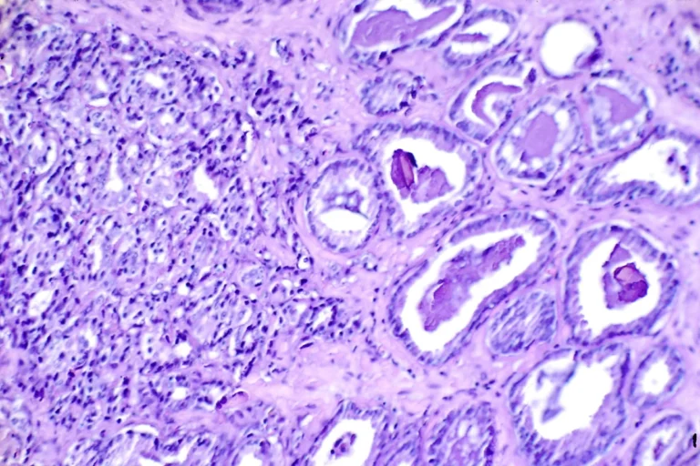 Innovation in Prostate Cancer Treatment: MultiValent Biotherapies Secures $27M Series A to Launch U.S. Trials
