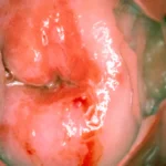 Rethinking CIN2: New Study Challenges Immediate Treatment Protocols for Cervical Precancer