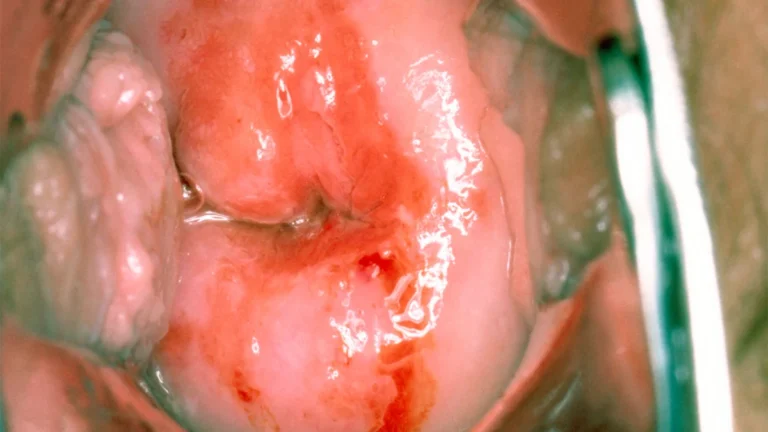 Rethinking CIN2: New Study Challenges Immediate Treatment Protocols for Cervical Precancer