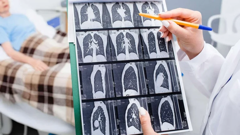 Rethinking Lung Cancer Screening: Could ‘Years-Smoked’ Thresholds Outperform Current Guidelines?